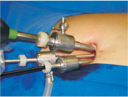 Gallbladder+surgery+scars hysterectomy scars pictures. Gallbladder+surgery+scars