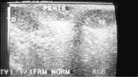 Ultra-sonografia no controle ps-operatrio final onde o testculo que teve os vasos ligados, foi o esquerdo