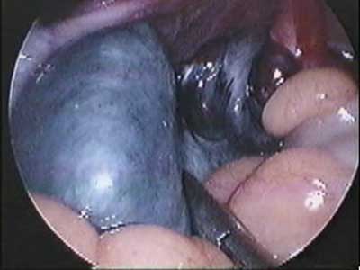 Ooforectomia por video / Video Oophorectomy 